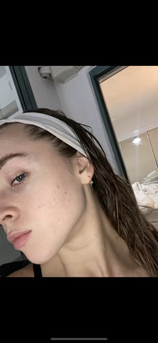 Customer photo review of Starter Acne Program™