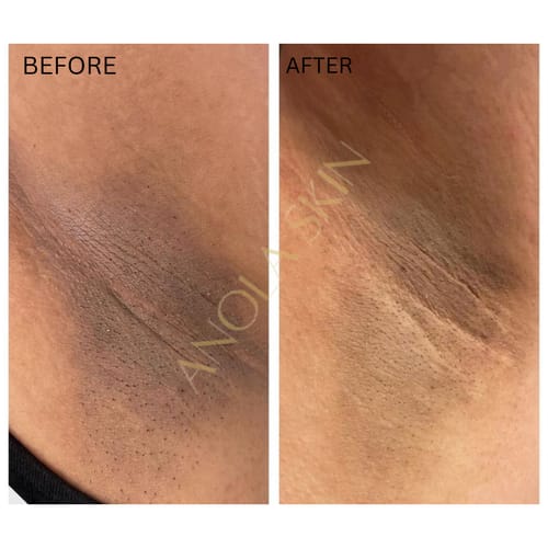 Customer photo review of Intense Discoloration Treatment (Rapid Action)