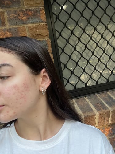 Customer photo review of Advanced Acne Program™
