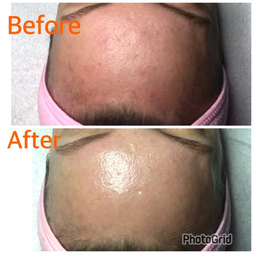 Customer photo review of KrX Green Sea Peel