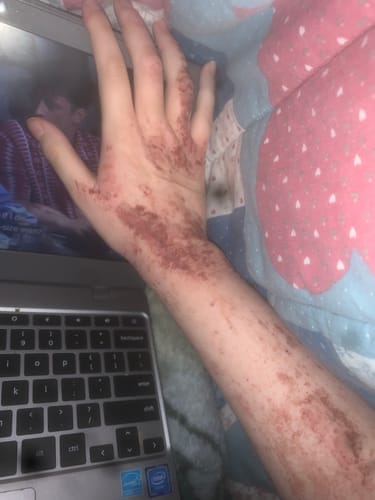 Customer photo review of Eczema Scratch Mitten
