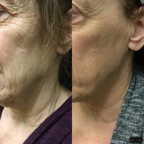 Customer photo review of Natural Botulin Lifting Creme