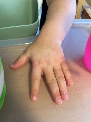 Customer photo review of All Over Ointment Eczema Treatment