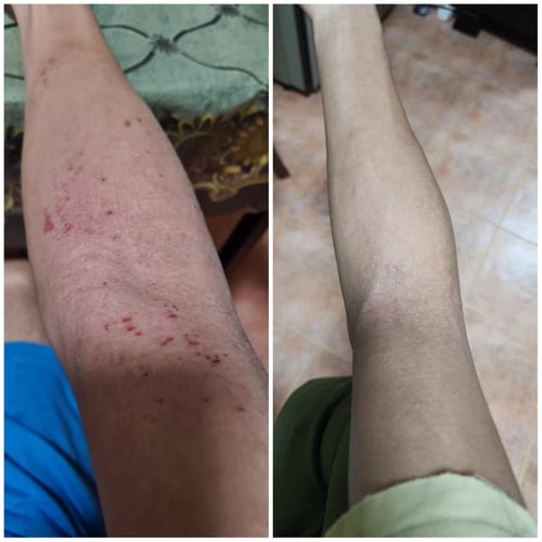 Customer photo review of Eczema Scratch Mitten