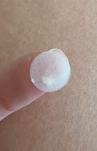 Customer photo review of Pimple Pals