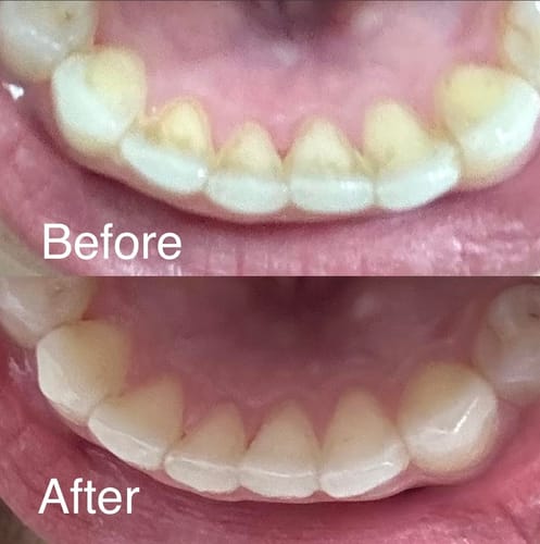 Customer photo review of Liroxa™ Ultrasonic Scaler Dental Pro