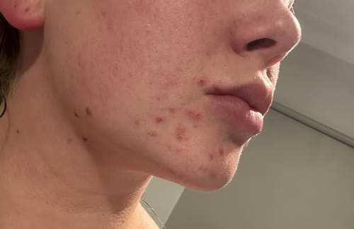 Customer photo review of Advanced Acne Program™