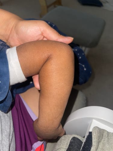 Customer photo review of All Over Ointment Eczema Treatment