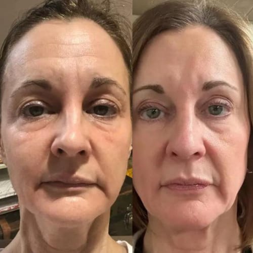 Customer photo review of Natural Botulin Serum