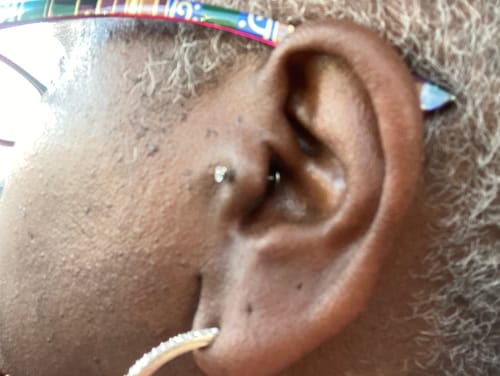 Customer photo review of Piercing Bump Treatment - Bump, Keloid & Scar Relief Oil