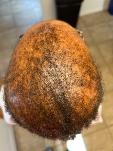 Customer photo review of PREMIUM HAIR GROWTH KIT