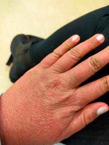 Customer photo review of Eczema Scratch Mitten