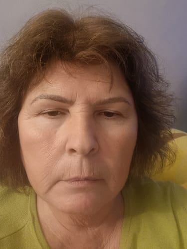 Customer photo review of The Microneedling Infusion System™