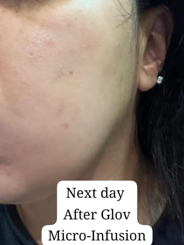 Customer photo review of Glov Micro Infusion System