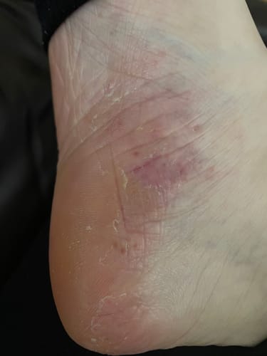 Customer photo review of Psoriasis Recommendations