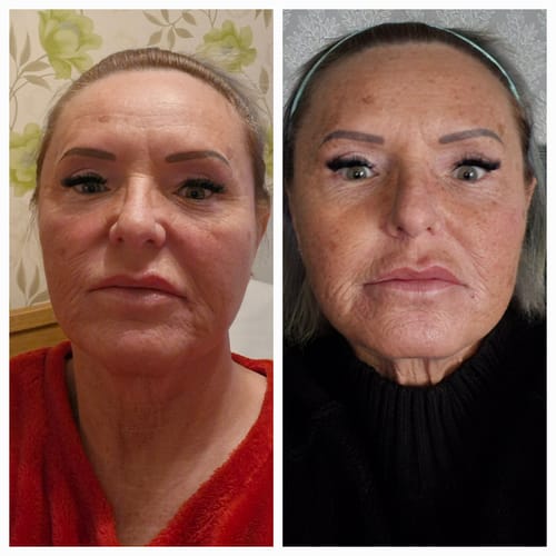 Customer photo review of 12-in-1 Micro Infusion System: Advanced Kit for 12 Professional-Grade Treatments