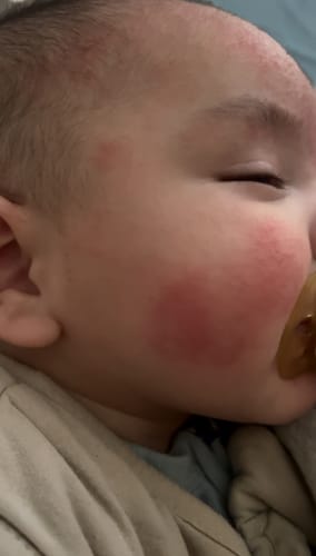 Customer photo review of All Over Ointment Eczema Treatment