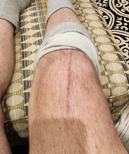 Customer photo review of Premium Bamboo Knee Sleeve (Single)