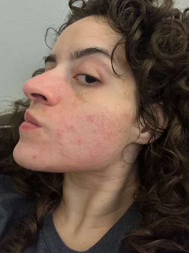Customer photo review of The Complete Acne System for Women