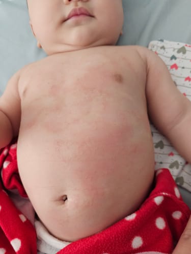 Customer photo review of All Over Ointment Eczema Treatment