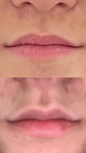 Customer photo review of LipFix: Filler