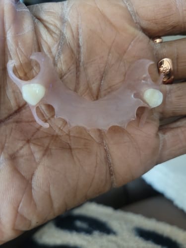 Customer photo review of Flexible Partial Denture, Includes 1 tooth