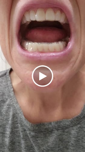 Customer video review of Upper and Lower Retainers Set