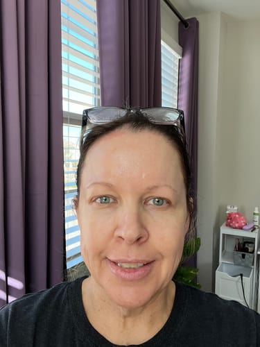 Customer photo review of JOVS 4D Laser Light Therapy Mask