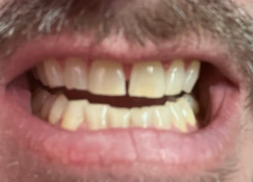 Customer photo review of ETERNAL TEETH WHITENING KIT