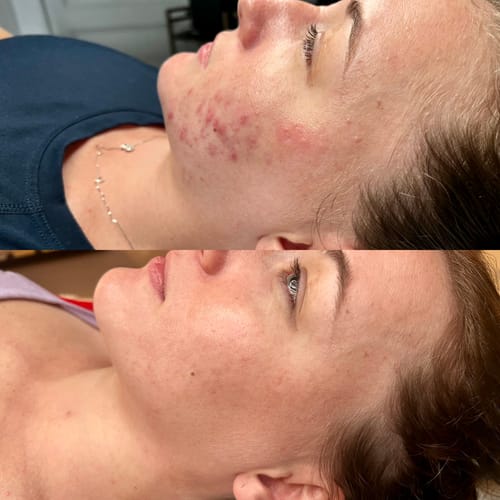 Customer photo review of KrX Clear Peel