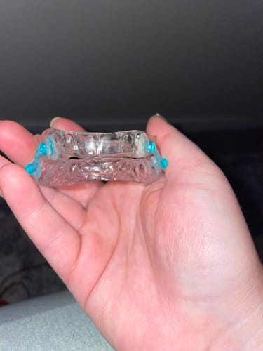Customer photo review of Sleep Apnea Appliance