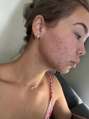 Customer photo review of Advanced Acne Program™