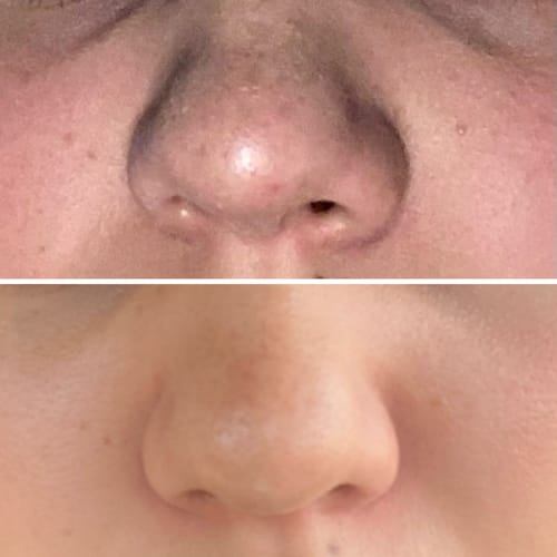 Customer photo review of SUERO HIDRATANTE - Ácido hialurónico