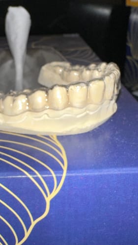 Customer photo review of Premium Sculpted Clear Retainer, Buy One Get One 50% Off BOGO! Use code: PSCR50