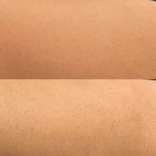 Customer photo review of WONDER SKIN HAIR REMOVAL ORGINAL CLASSIC PRO (2in1 Modi)