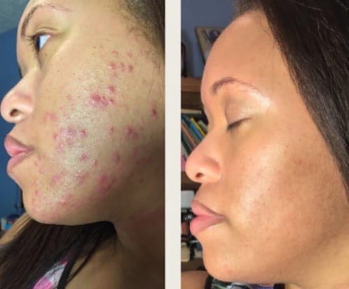 Customer photo review of 24k Golden Glow Essential Acne Kit