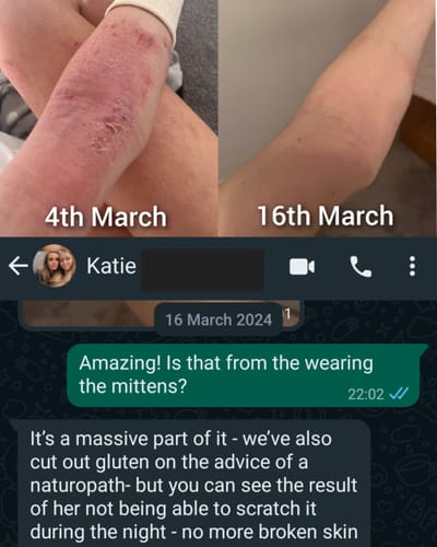 Customer photo review of Eczema Scratch Mitten