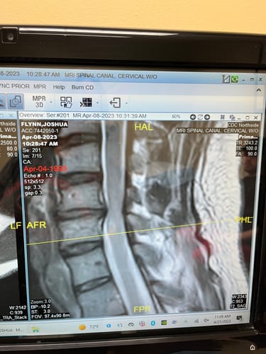 Customer photo review of Ultimate Joint Bundle 10.00% Off Auto renew (Ships every 30 Days)