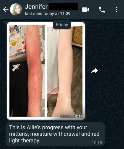 Customer photo review of Eczema Scratch Mitten