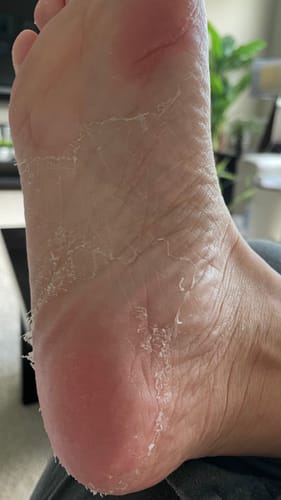 Customer photo review of Korean Foot Peel