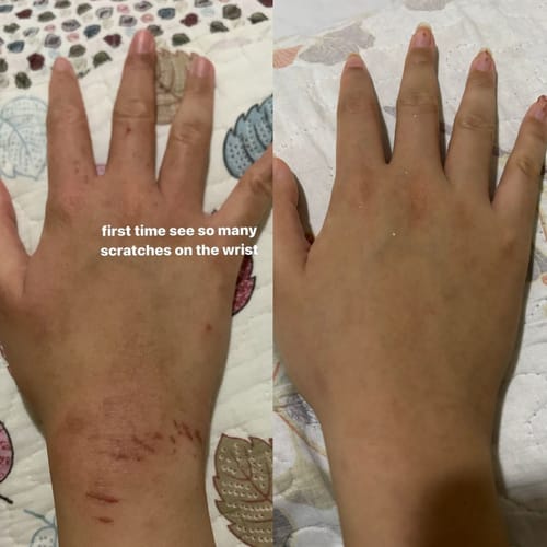 Customer photo review of Eczema Scratch Mitten