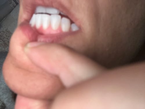 Customer photo review of GLO405™ Whitening Light