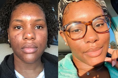Customer photo review of 24k Golden Glow Essential Acne Kit
