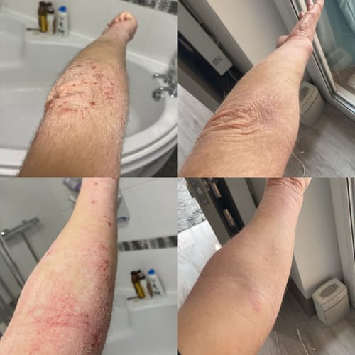 Customer photo review of Eczema Scratch Mitten