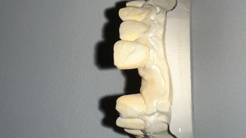 Customer photo review of Partial Denture Clear Retainer, Includes 1 Tooth