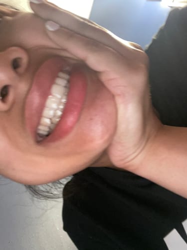 Customer photo review of Upper and Lower Retainers Set