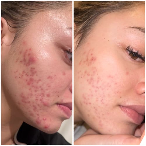 Customer photo review of Advanced Acne Program™