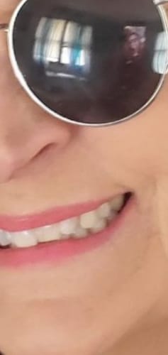 Customer photo review of Flexible Partial Denture, Includes 1 tooth, Save $52 with promotional code:TCG15