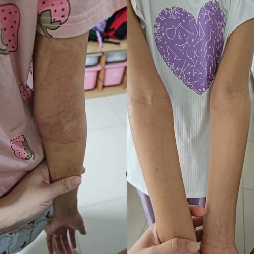 Customer photo review of Eczema Scratch Mitten