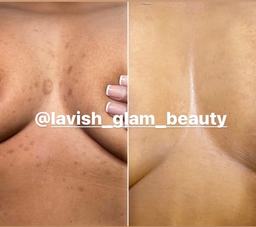 Customer photo review of Glass Skin Brighten Up Pads (Turmeric & kojic acid)